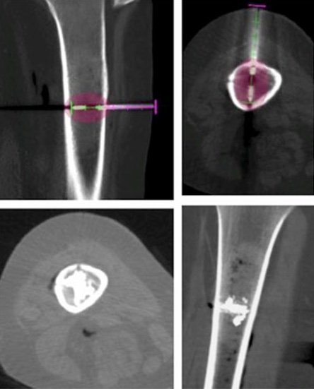 Risonanza magnetica per rilevare la diffusione dei tumori ossei