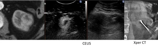 Procedura di ablazione del tumore renale eseguita con guida ecografica e tomografia a raggi X (CBCT) per trattamenti minimamente invasivi dei tumori renali