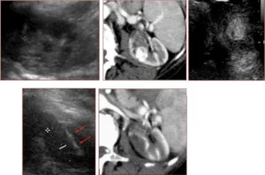 Ablazione di un tumore renale con guida ecografica e TC (tomografia computerizzata)