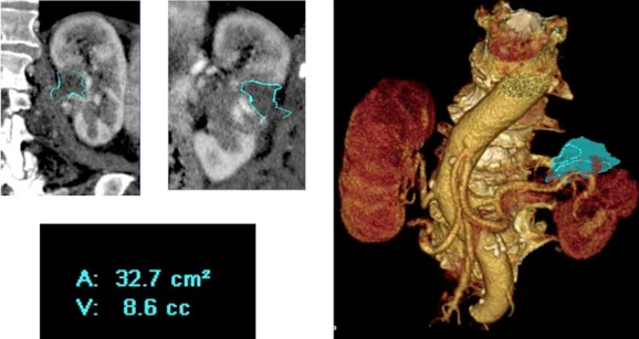 Trattamento di ablazione per tumore renale eseguito con guida ecografica e tomografia computerizzata (TC), un'opzione sicura per il trattamento dei tumori renali