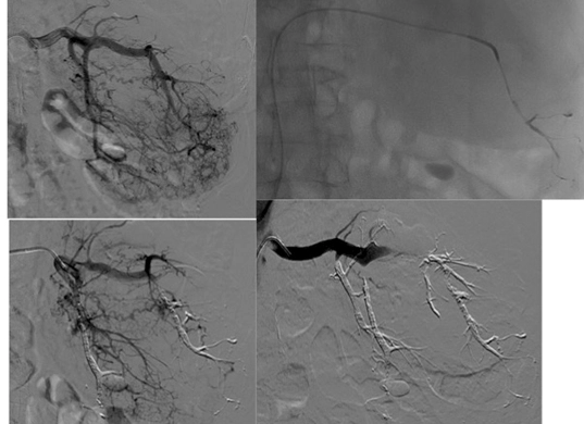 Tumore renale sanguinante di grandi dimensioni che ha causato anemizzazione, una condizione grave che richiede trattamenti urgenti per il tumore renale