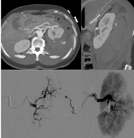 Ablazione di tumore renale di piccole dimensioni (