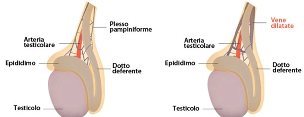 Spermiogramma per valutare la fertilità dopo trattamento del varicocele