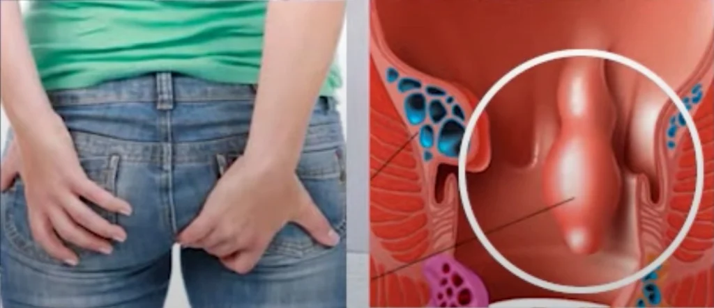 Soluzione mininvasiva per le emorroidi tramite embolizzazione dell'arteria rettale superiore, una tecnica avanzata di radiologia interventistica.