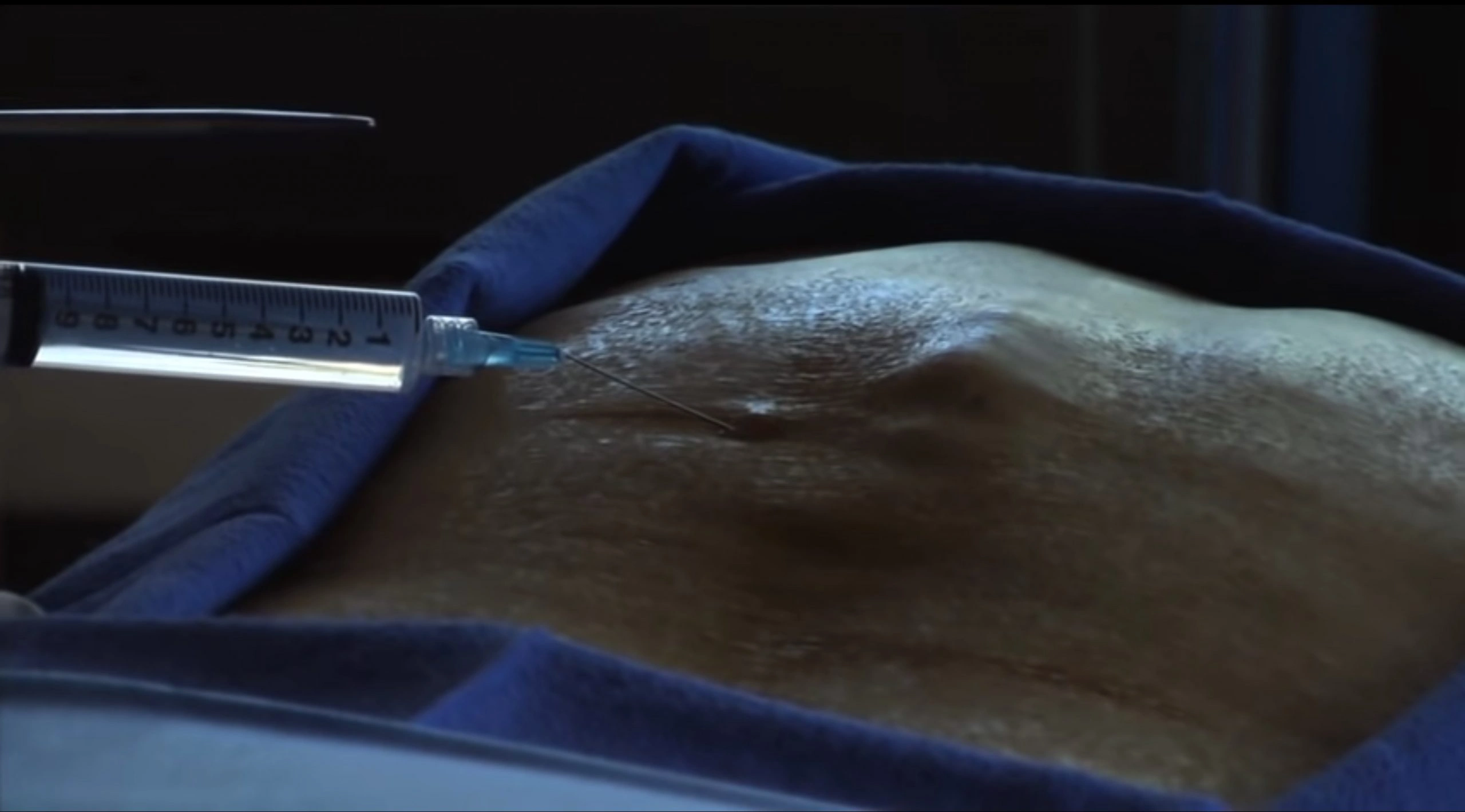 Vertebroplastica2-milano