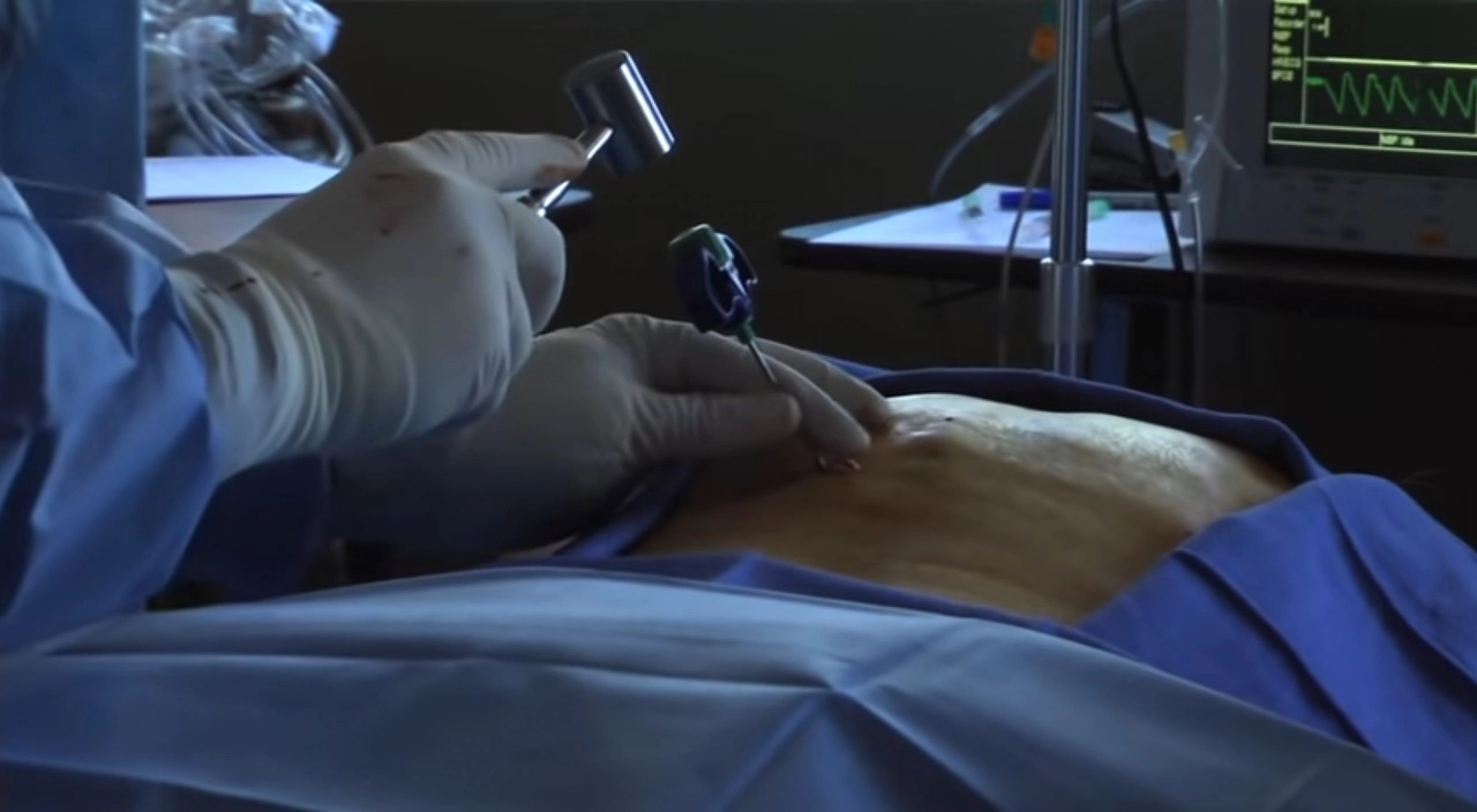 Vertebroplastica3-ierardi