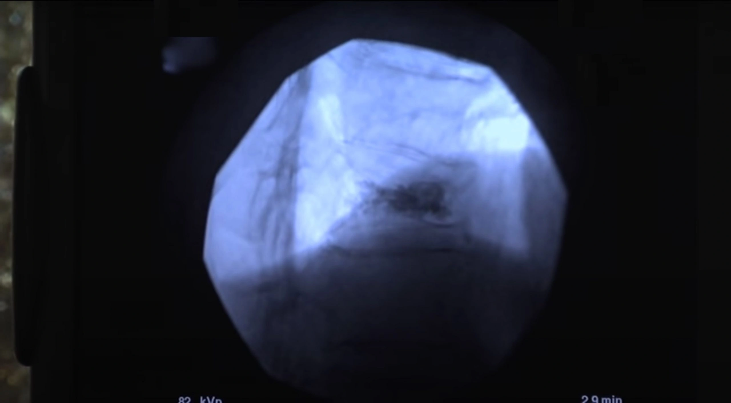 Vertebroplastica5-mi